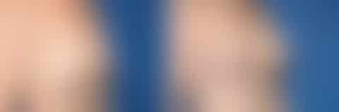 Breast Lift Before and After Photos in New York, NY, Patient 13567