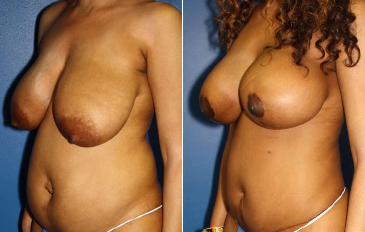 Mommy Makeover Before and After Photos in New York, NY, Patient 13580