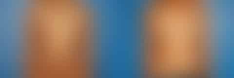 Breast Augmentation Before and After Photos in New York, NY, Patient 13756