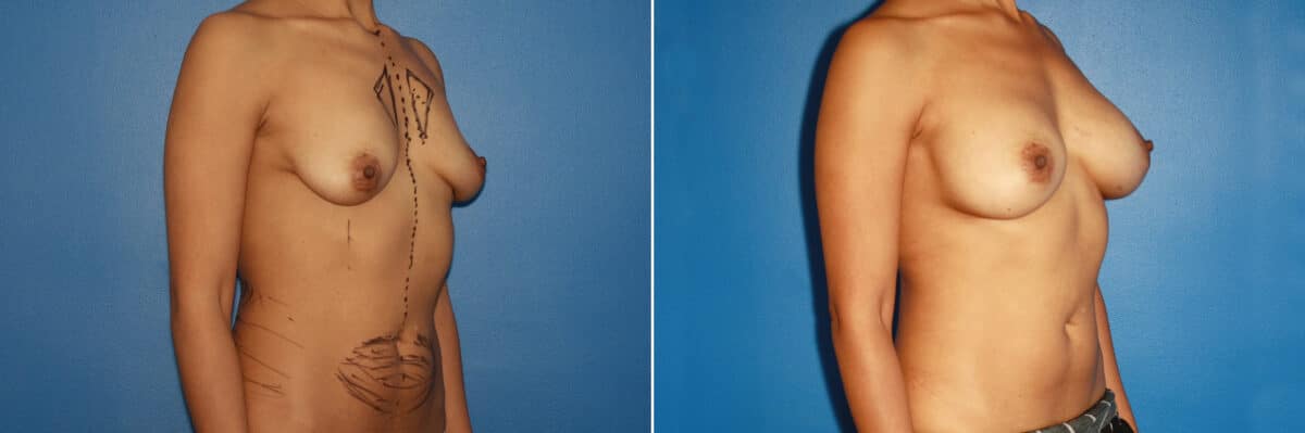 Breast Augmentation Before and After Photos in New York, NY, Patient 13756