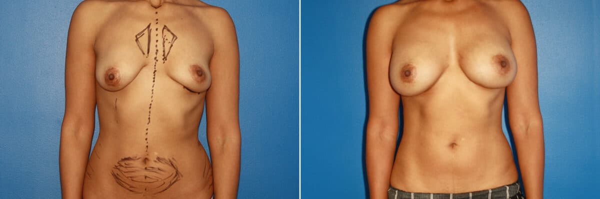 Breast Augmentation Before and After Photos in New York, NY, Patient 13756