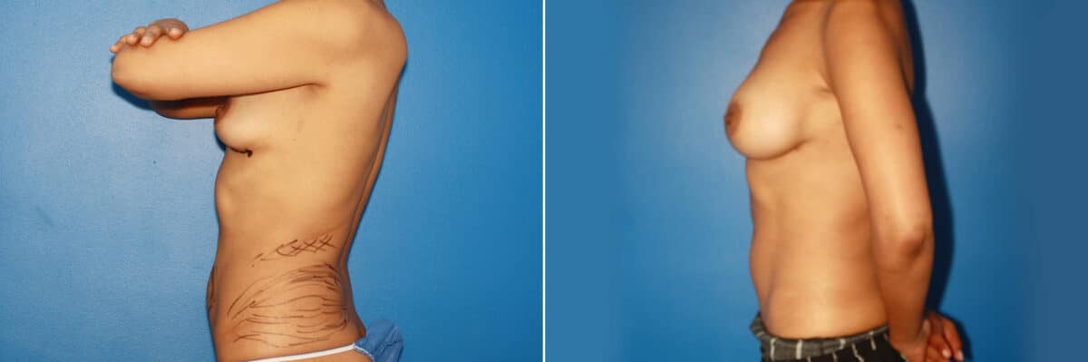 Breast Augmentation Before and After Photos in New York, NY, Patient 13756