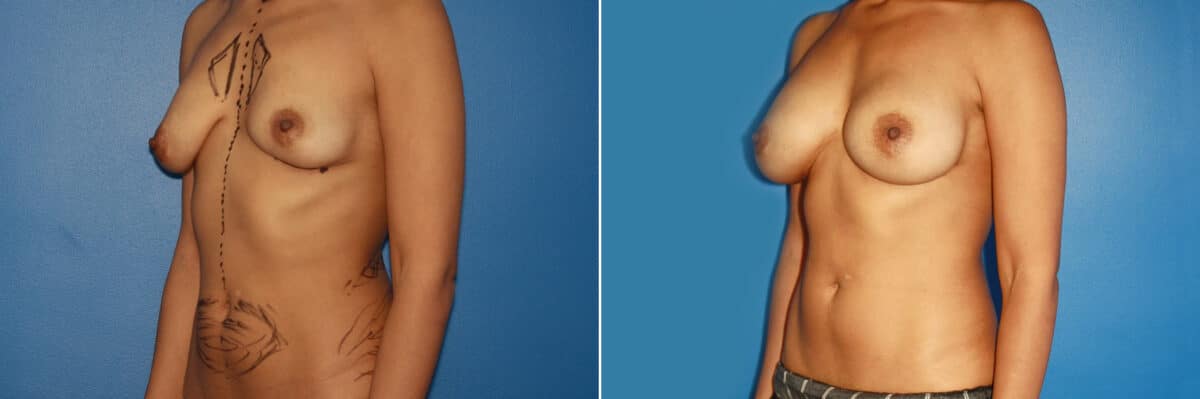 Breast Augmentation Before and After Photos in New York, NY, Patient 13756