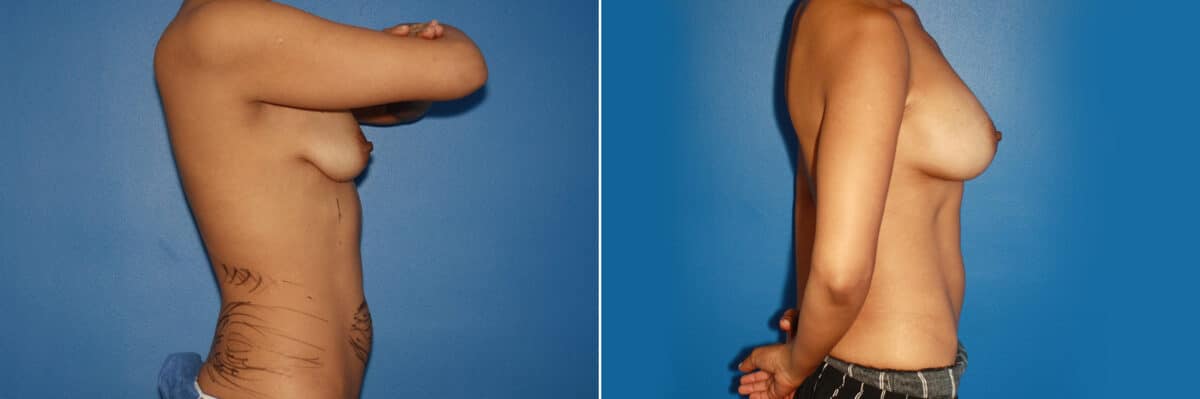 Breast Augmentation Before and After Photos in New York, NY, Patient 13756