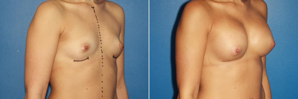 Breast Augmentation Before and After Photos in New York, NY, Patient 13774