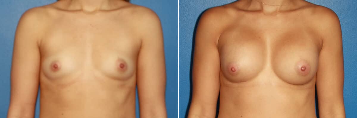 Breast Augmentation Before and After Photos in New York, NY, Patient 13774