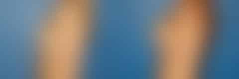 Breast Augmentation Before and After Photos in New York, NY, Patient 13774