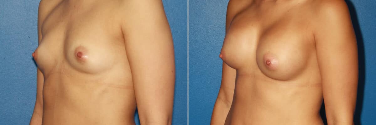 Breast Augmentation Before and After Photos in New York, NY, Patient 13774
