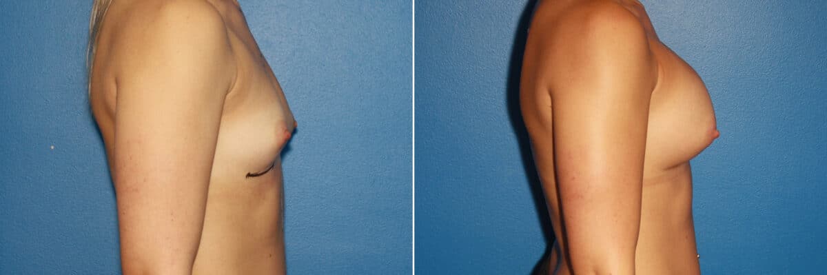 Breast Augmentation Before and After Photos in New York, NY, Patient 13774