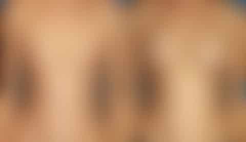 Breast Augmentation Before and After Photos in New York, NY, Patient 13790