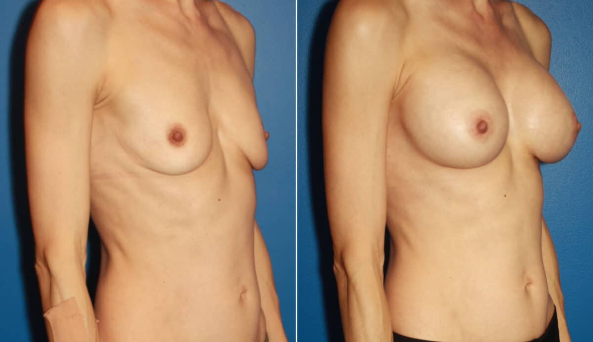 Breast Augmentation Before and After Photos in New York, NY, Patient 13790
