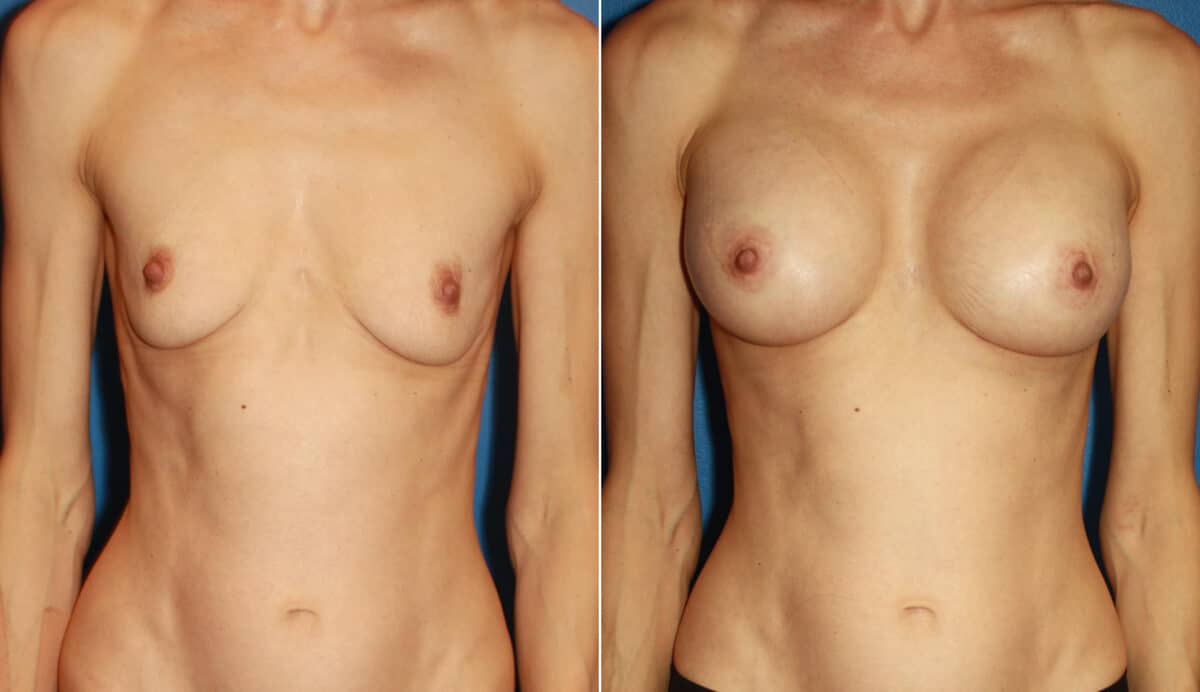 Breast Augmentation Before and After Photos in New York, NY, Patient 13790