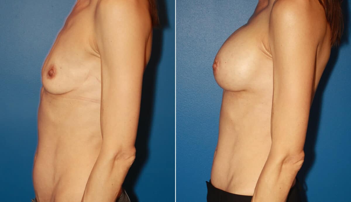 Breast Augmentation Before and After Photos in New York, NY, Patient 13790