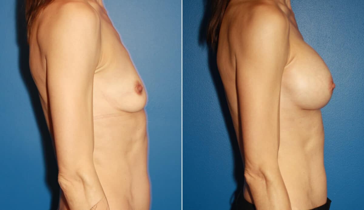 Breast Augmentation Before and After Photos in New York, NY, Patient 13790