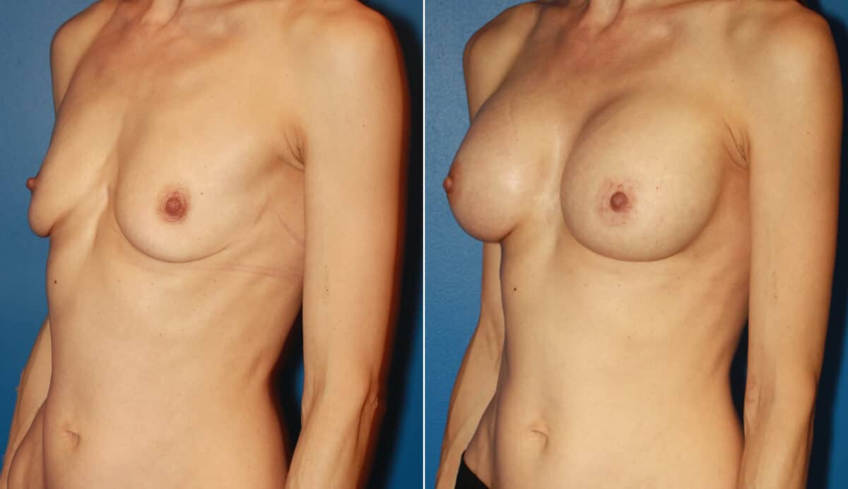 Breast Augmentation Before and After Photos in New York, NY, Patient 13790