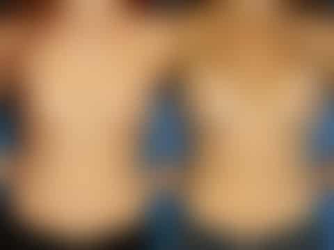 Breast Augmentation Before and After Photos in New York, NY, Patient 13806