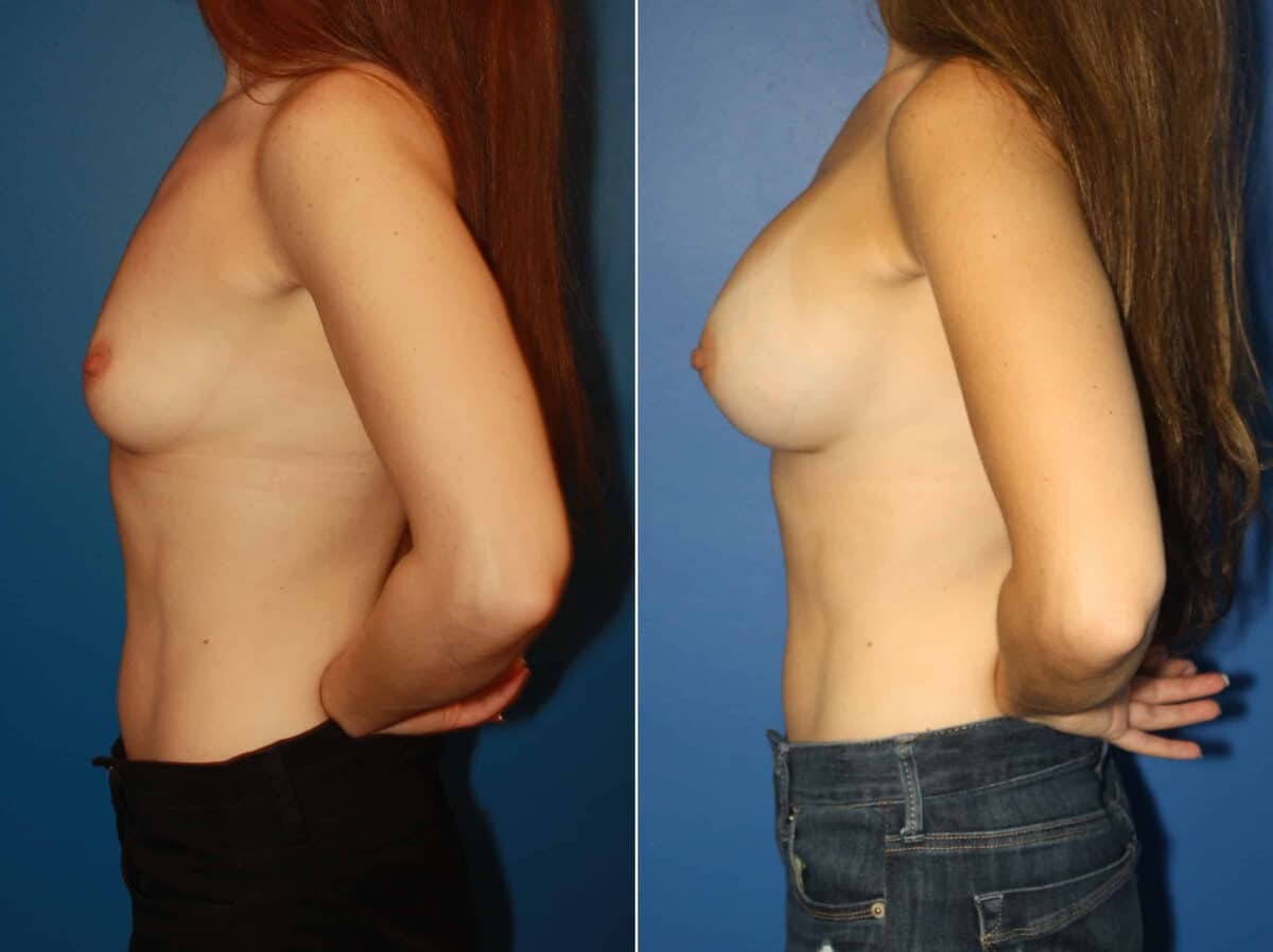 Breast Augmentation Before and After Photos in New York, NY, Patient 13806