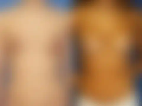 Breast Augmentation Before and After Photos in New York, NY, Patient 13822