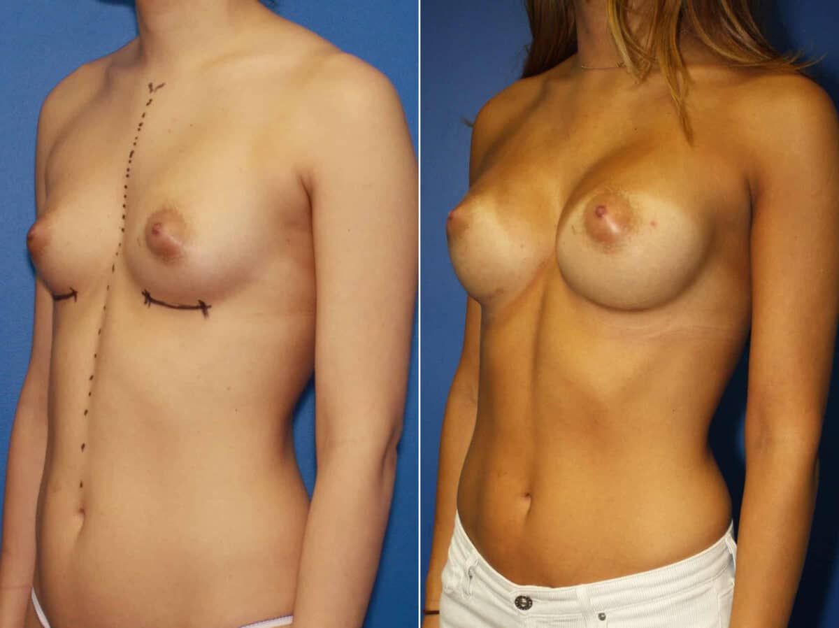 Breast Augmentation Before and After Photos in New York, NY, Patient 13822