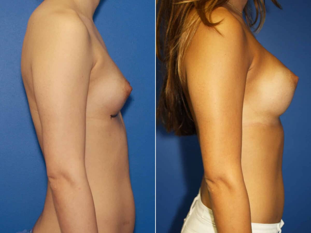 Breast Augmentation Before and After Photos in New York, NY, Patient 13822