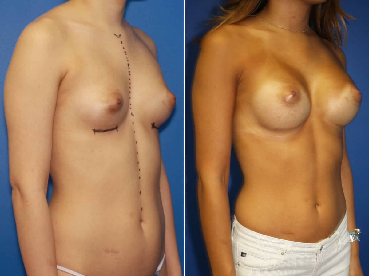 Breast Augmentation Before and After Photos in New York, NY, Patient 13822