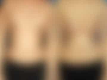 Breast Augmentation Before and After Photos in New York, NY, Patient 13838