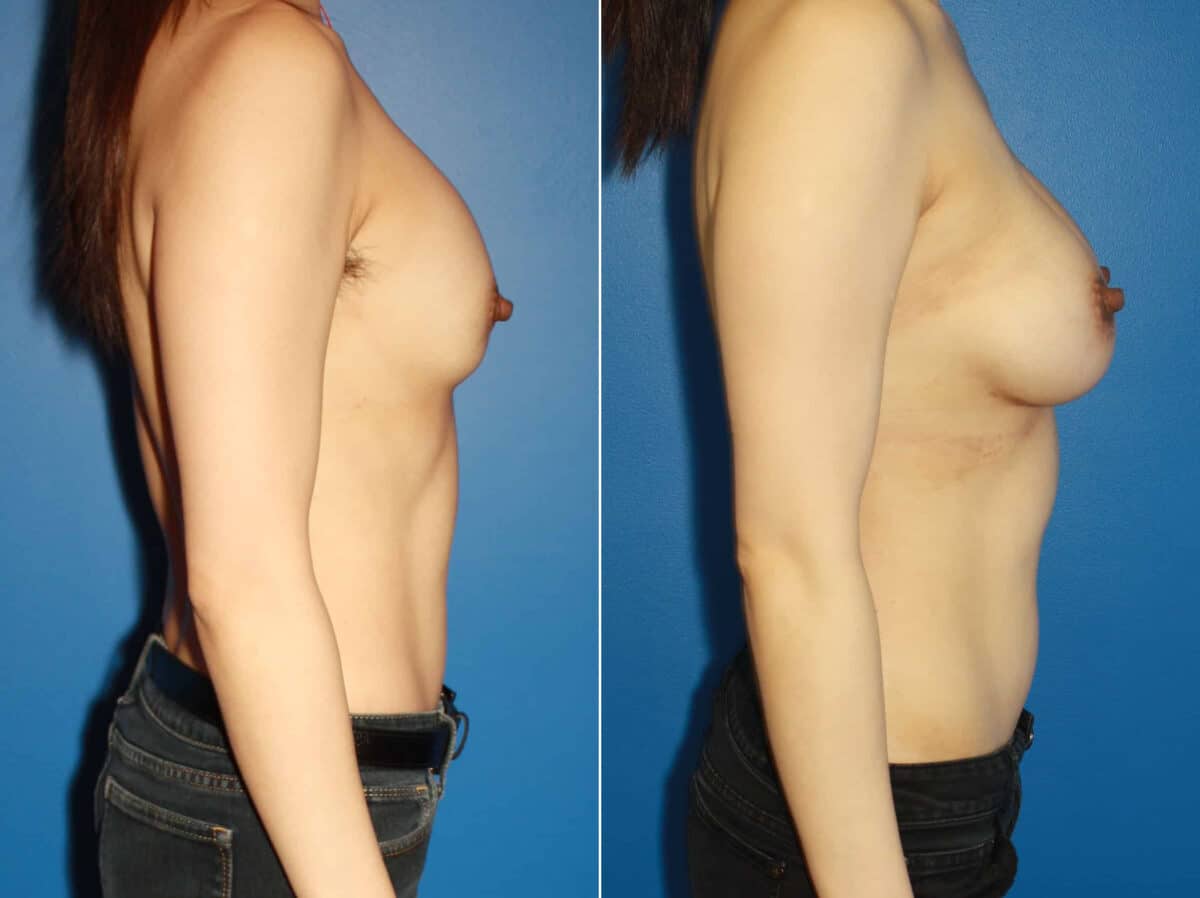 Breast Augmentation Before and After Photos in New York, NY, Patient 13838