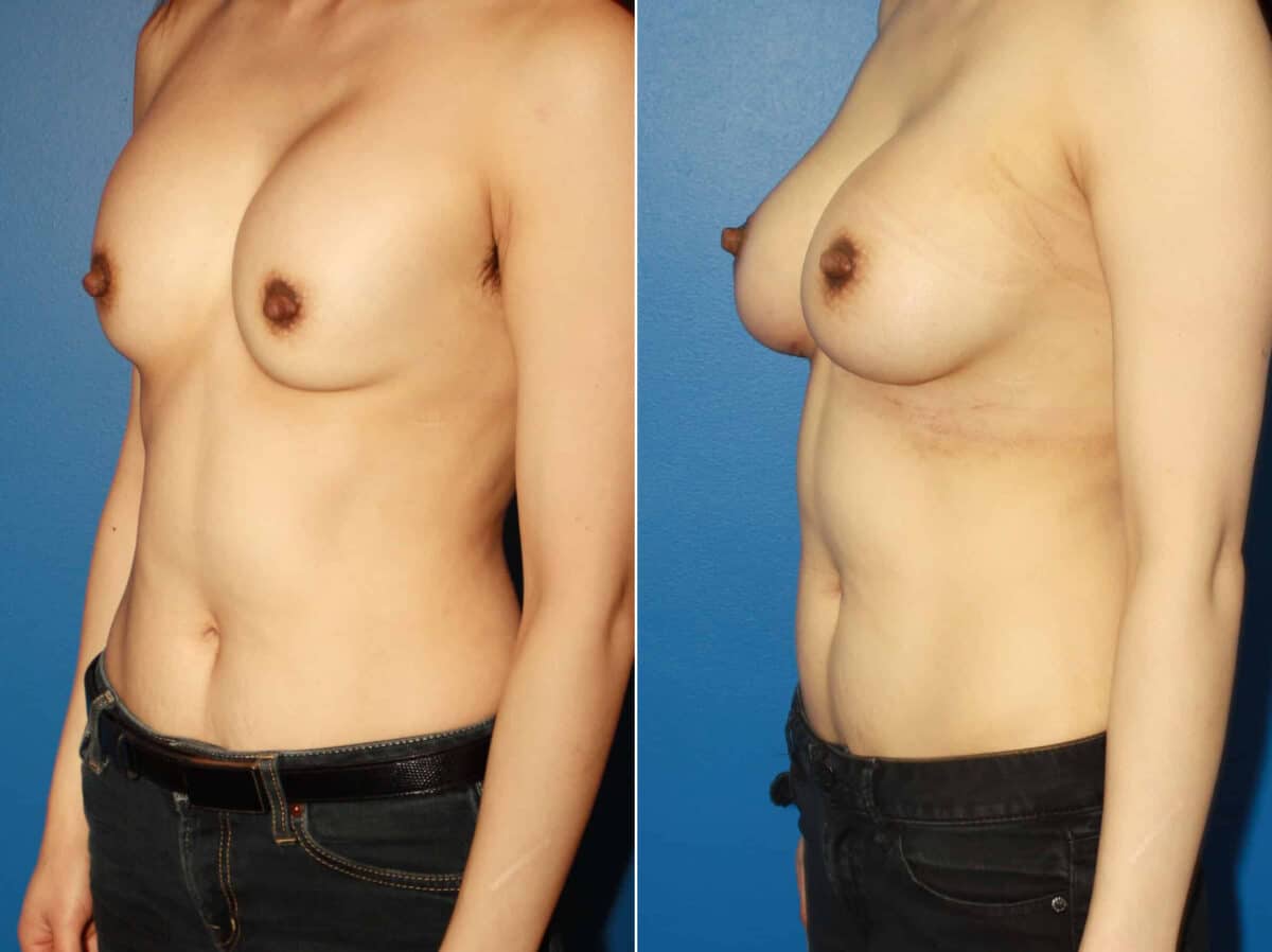 Breast Augmentation Before and After Photos in New York, NY, Patient 13838