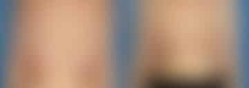 Breast Augmentation Before and After Photos in New York, NY, Patient 13876
