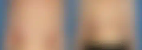 Breast Augmentation Before and After Photos in New York, NY, Patient 13876