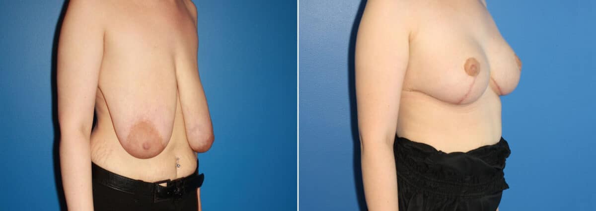 Breast Augmentation Before and After Photos in New York, NY, Patient 13876