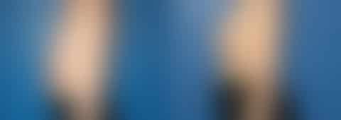Breast Augmentation Before and After Photos in New York, NY, Patient 13876
