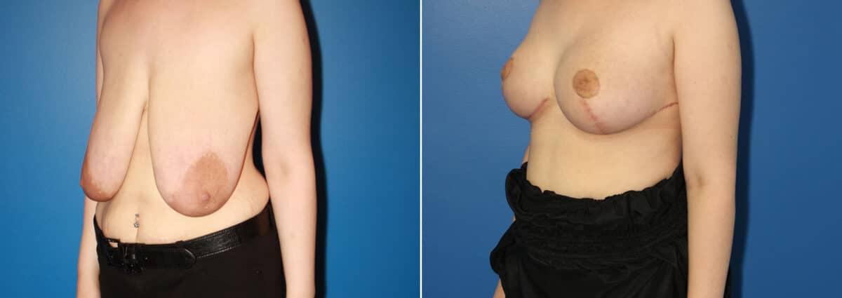 Breast Augmentation Before and After Photos in New York, NY, Patient 13876