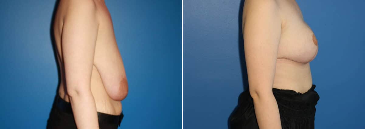 Breast Augmentation Before and After Photos in New York, NY, Patient 13876