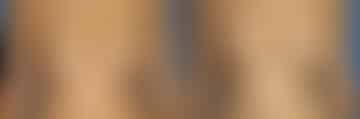 Breast Lift Before and After Photos in New York, NY, Patient 13892