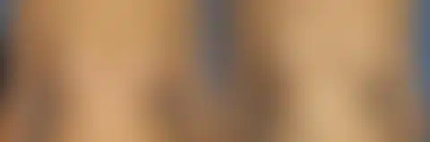 Breast Lift Before and After Photos in New York, NY, Patient 13892