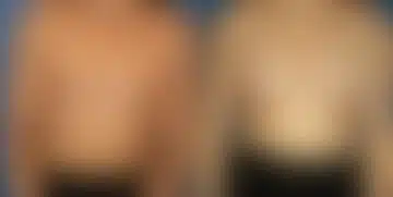 Breast Augmentation Before and After Photos in New York, NY, Patient 13908