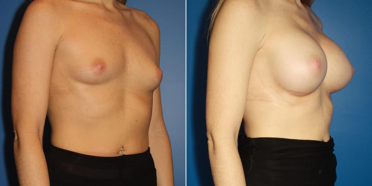 Breast Augmentation Before and After Photos in New York, NY, Patient 13908