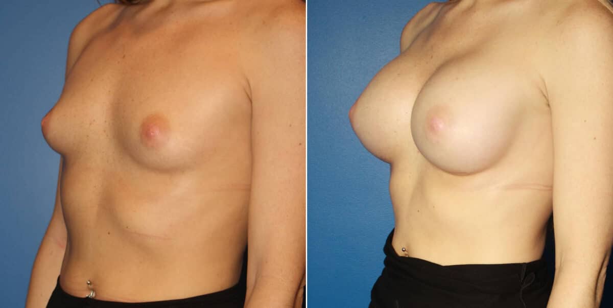 Breast Augmentation Before and After Photos in New York, NY, Patient 13908