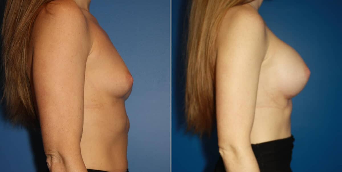 Breast Augmentation Before and After Photos in New York, NY, Patient 13908