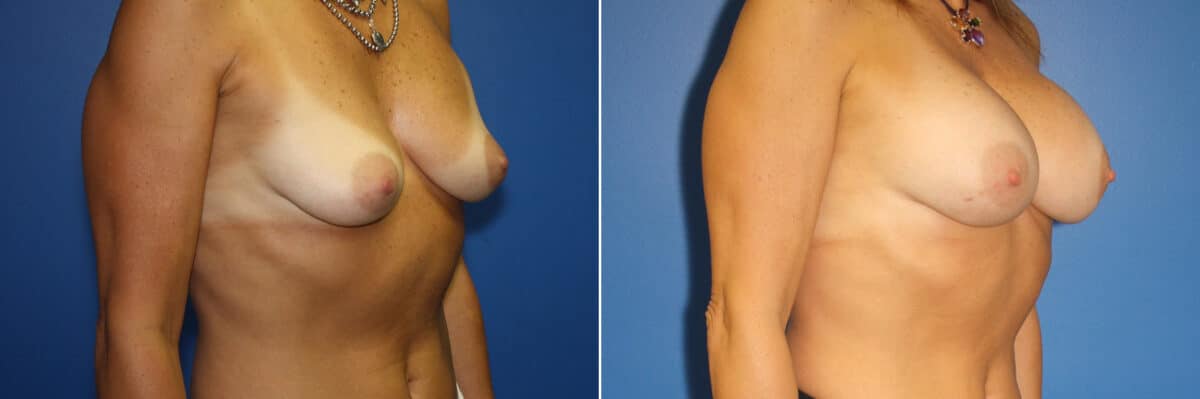 Breast Augmentation Before and After Photos in New York, NY, Patient 13942