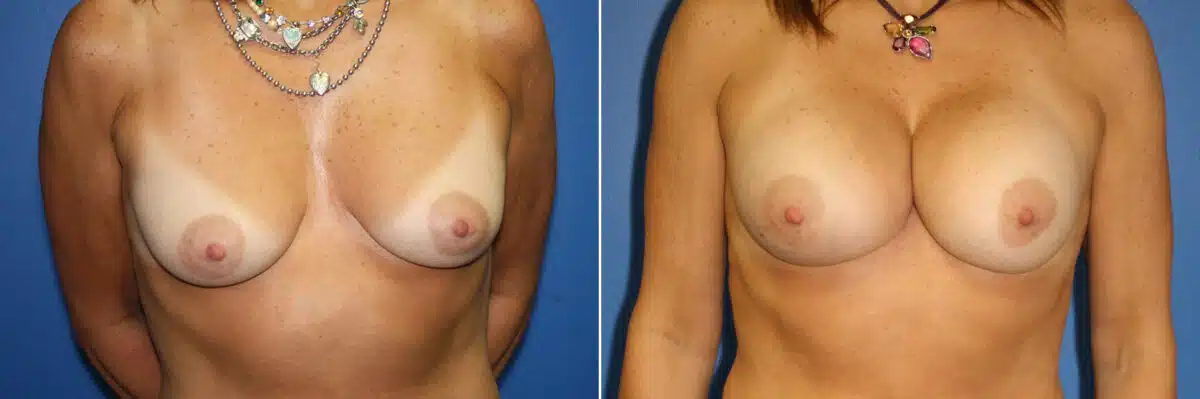 Breast Augmentation Before and After Photos in New York, NY, Patient 13942