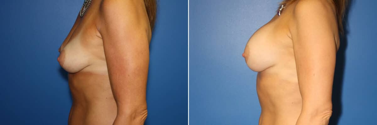 Breast Augmentation Before and After Photos in New York, NY, Patient 13942