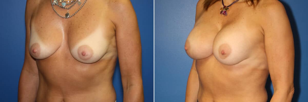 Breast Augmentation Before and After Photos in New York, NY, Patient 13942