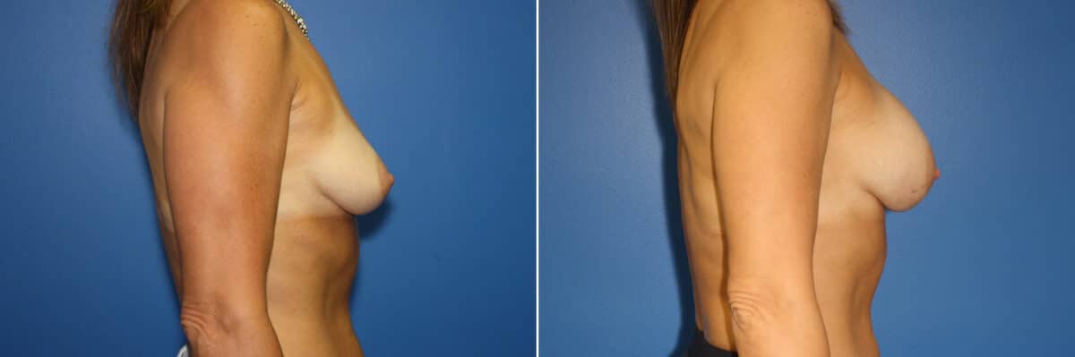 Breast Augmentation Before and After Photos in New York, NY, Patient 13942