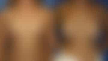 Breast Augmentation Before and After Photos in New York, NY, Patient 13959