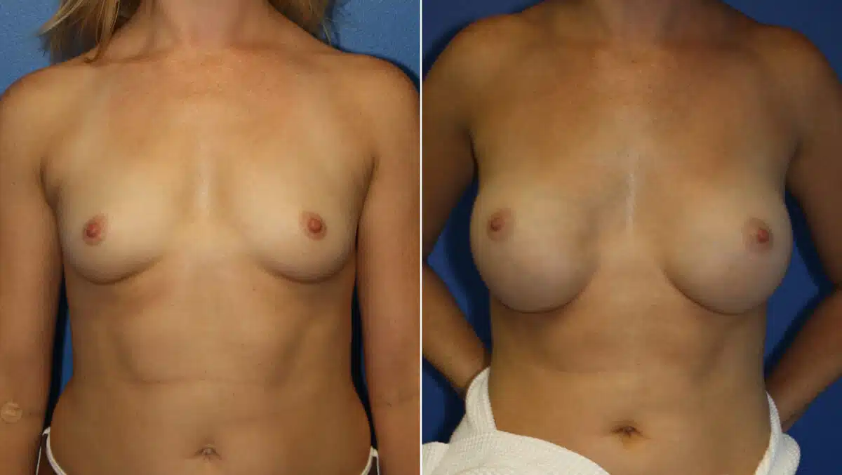 Breast Augmentation Before and After Photos in New York, NY, Patient 13959