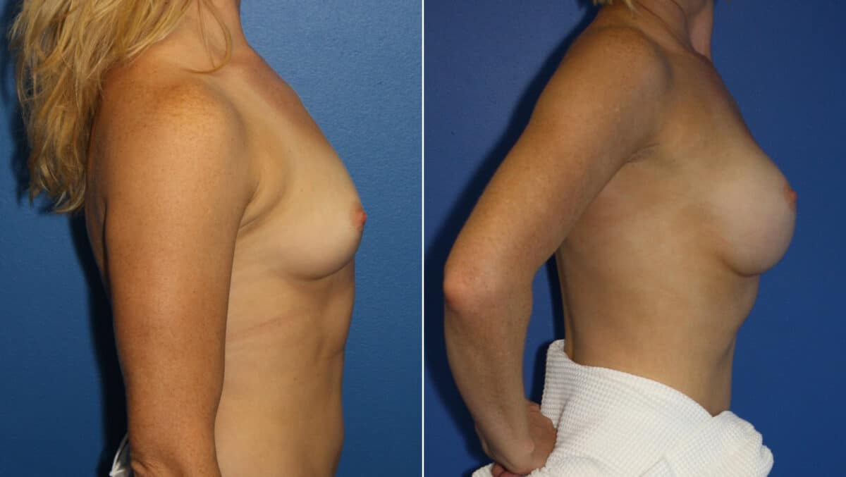 Breast Augmentation Before and After Photos in New York, NY, Patient 13959