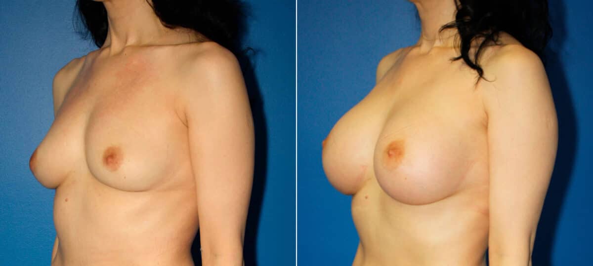 Breast Augmentation Before and After Photos in New York, NY, Patient 15449