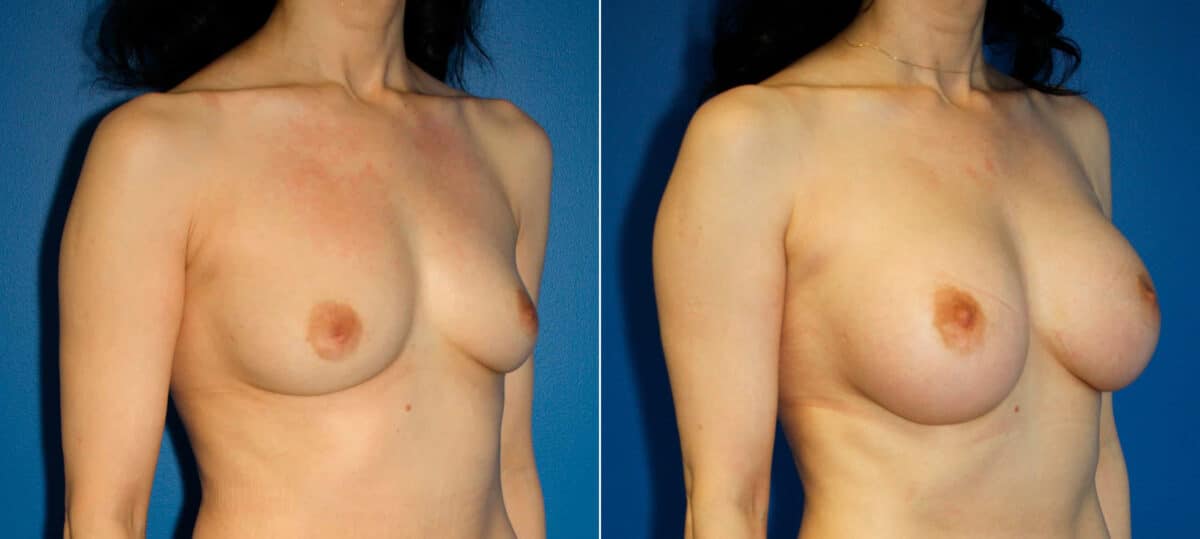Breast Augmentation Before and After Photos in New York, NY, Patient 15449